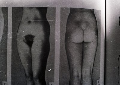 Medical X-ray of pelvic region showing pre- and post-operative comparison. Likely 20th-century clinical imaging, possibly –. ...