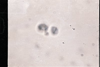 Microscopic view of two clustered cells, likely stained for contrast. Appears to be a historical medical slide, possibly from...
