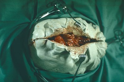 Surgical view showing an open abdominal cavity, displaying internal organs. Tissue retractors hold back the abdominal wall. L...