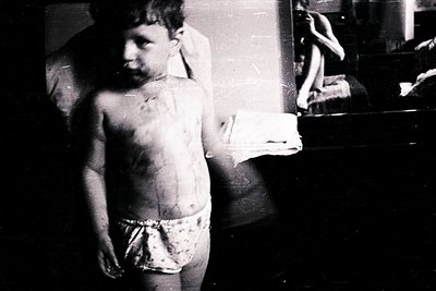 Black-and-white portrait of a young boy in a dimly lit room, shirtless with visible scars on his torso. He holds a folded clo...