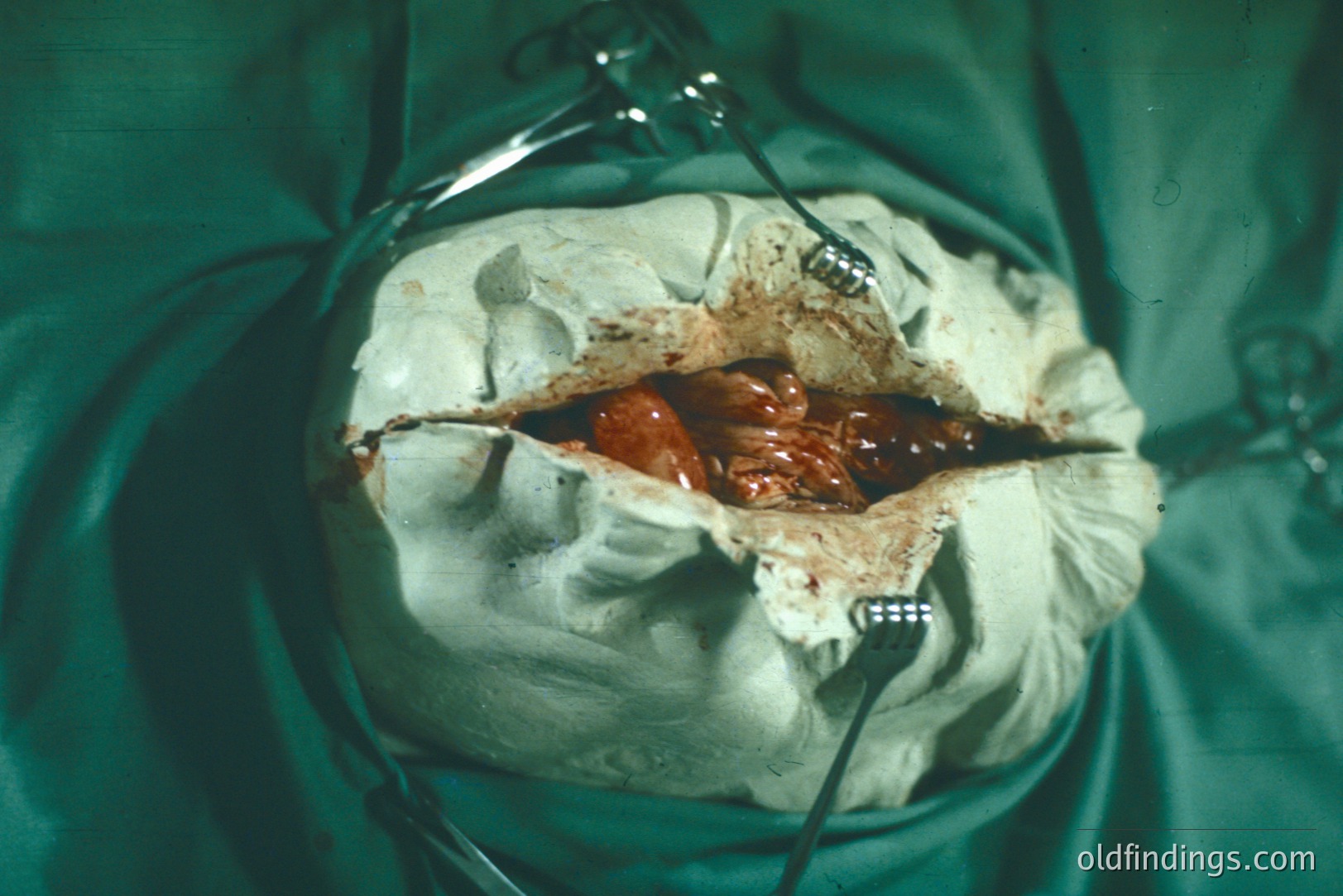 Surgical view showing an open abdominal cavity, displaying internal organs. Tissue retractors hold back the abdominal wall. Likely a medical training or documentation photograph. The backdrop is a green surgical drape.