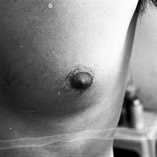 Prominent umbilical hernia with protruding tissue.