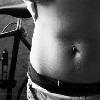 Severe abdominal distension in individual.