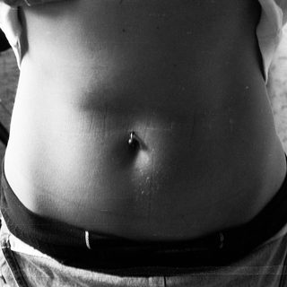 Severe abdominal distension in individual.