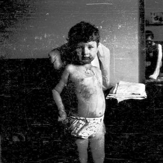 Child with severe skin lesions indoors.
