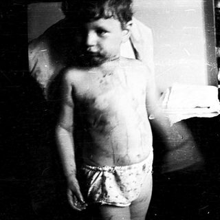 Shirtless child with visible scars indoors.