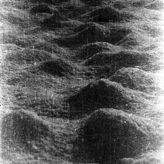 Mammogram showing dense breast tissue.